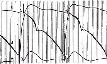 Определение времени запаздывания пульсовой волны по началу подъема восходящего колена кривых (по В. П. Никитину)