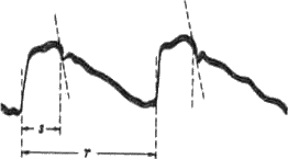 Определение времени изгнания (5) и времени полной инволюции сердца (Т) по кривой центрального пульса (по В.П. Никитину)